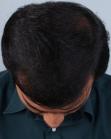 After Hair Transplant&nbsp;Midscalp